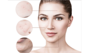 Acne & Acne Scar Treatment